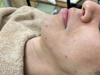 ナノハナの写真/【美肌本格ひげ脱毛】はナノハナで！痛み最小限で効果を実感する脱毛◎毎日のシェービングから解放！