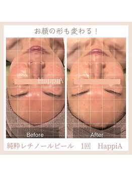 ハピア(HappiA)/純粋レチノールピール