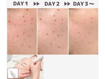 マヴィ くずは店(MavY.)/シミ改善