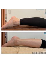 ビーラボ(Be Lab)/筋膜矯正 施術Before→After