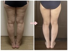 ディオ(Dio)/太ももの張り・セルライト