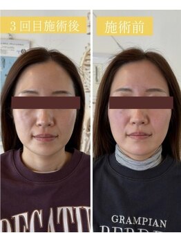 りせる整体院(Recell)/小顔矯正 三回目
