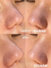 ラエッセ 恵比寿(LAESSE)/【毛穴の開き・毛穴黒ずみ改善】