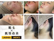 アルゴ 八幡黒崎店(ALGO)の雰囲気（【脱毛×フェイシャルエステ】で本気の肌質改善）