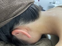 ミース 越谷店/うなじ矯正●Before、After