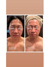 白美/脂肪分解／レッドショット