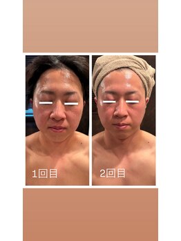白美/脂肪分解／レッドショット
