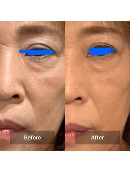 ヨサ パーク コアハート(YOSA PARK CORE HEART)/目元、口元効果あり