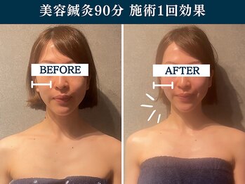 シンク(CINQ)/ウェディング前小顔美容骨格調整