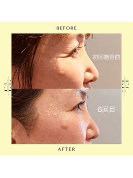 ニコホリ(NIKOHORI)/エクソリフト/フェイシャル/美肌