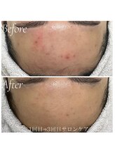 ミラリー(MIRALY)/おでこニキビケア 3ヶ月(20代)