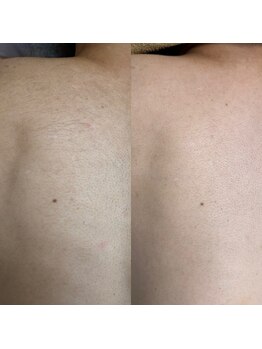 フェリーチェネイル(felice Nail)/背中脱毛