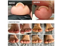 カンパニュラ(Campanula)/時間をかけて広がる巻き爪ケア