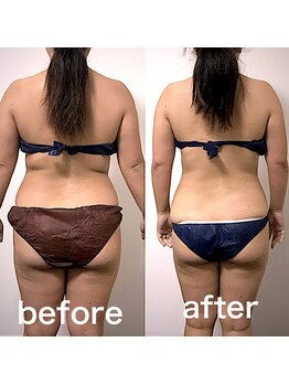 エステサロンクオーツ/背中のお肉りスッキリ♪