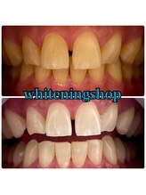 ホワイトニングショップ 吉祥寺店/BEFORE ＆ AFTER