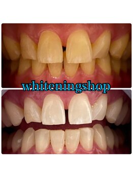 ホワイトニングショップ 吉祥寺店/BEFORE ＆ AFTER