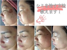 ルノン(LUNON)の雰囲気（シミができる原因、良くならない理由教えます！）