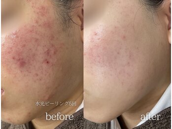 ミレット(Miretto)/【ニキビ・乾燥】水光ピーリング