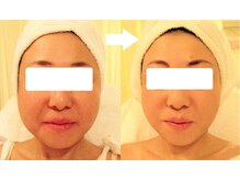 サロンドエステケイワイ(de KY)/フェイシャル☆小顔・タルミ改善