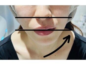 クリオ(Crio)/光フェイシャル