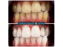 ホワイトニングショップ 天王寺店/10回ご来店後のお写真です