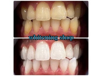 ホワイトニングショップ 天王寺店/10回ご来店後のお写真です