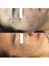 グランヴェルジェ(Granverger)/陶肌トリートメント