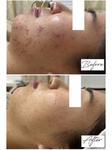 ビズビズ 梅田店(bisebise)/〈症例〉ニキビケア・赤み・跡