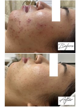 ビズビズ 梅田店(bisebise)/〈症例〉ニキビケア・赤み・跡