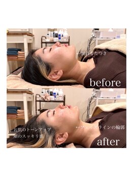 ライム 松本(LIME)/《Hi-UP*顎下/二重あご改善》