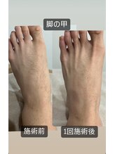 るあん/美肌脱毛