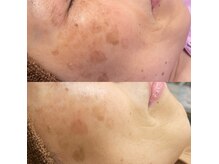 モルセラ(Moluccella)/3回の施術