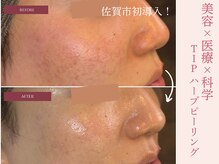 ビエン(美艶 b.en)の雰囲気（肌トラブルに◎ダウンタイムなし！ハーブピーリング￥9,000）