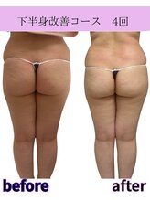 リラ(Lilas)/【痩身】たるみ改善下半身　4回