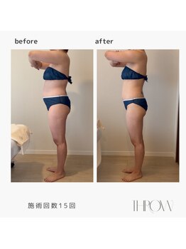 スロウ(THROW)/インディバ　体質ケア・痩身