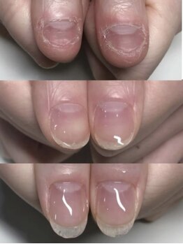 ティアラネイル 宇都宮/深爪矯正