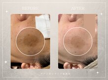 アバンダンティア 姫路店/MTメタトロンコース＋シミケア