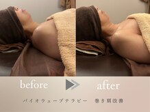 グロッシー(glossy)/【症例】電流エステ　巻き肩