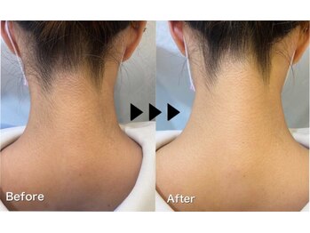 アイリス 川崎/【背中脱毛】肩~腰まで全て脱毛