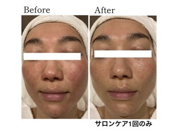 エラフリー/ずっとニキビ/赤みでお悩みの肌