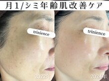 トリニエンス 新宿店(TRINIENCE)/60代/シミケア/年齢肌ケア