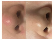 ルミエール シーサイド(L’MIERE seaside)/皮脂抑制で赤み改善