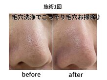 アルゴ 八幡黒崎店(ALGO)/毛穴洗浄でごっそり毛穴お掃除♪