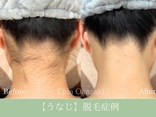 エピア 岡崎店(Epia)/うなじ脱毛　10回の変化