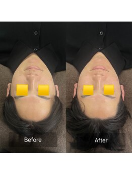 トニック バイ まつもと整骨院鍼灸院(Tonic)/★Before After★豊中/小顔