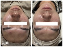 ビズビズ(bisebise)/メンズニキビ改善専門のプロ集団