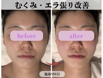 ミピマム 横浜駅前店/むくみ・エラ張り改善