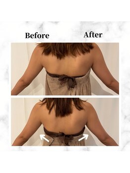 ザビューティー 麻布十番本店(The Beauty)/二の腕リフト打ち放題[リフト]