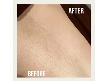 メローワックス 松本駅前店(MELLOW WAX)/お背中のワックス脱毛