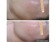 アンジェリーク/シミケア実績15年BA多数